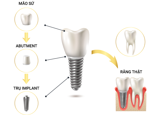 cấy ghép Implant