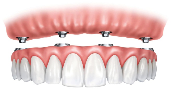 Phương pháp cấy ghép Implant All On 4