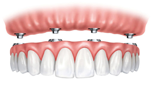 Những ai không thích hợp trồng răng implant?