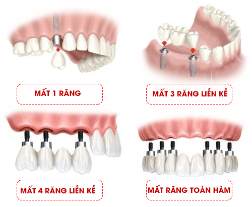 Cấy ghép implant